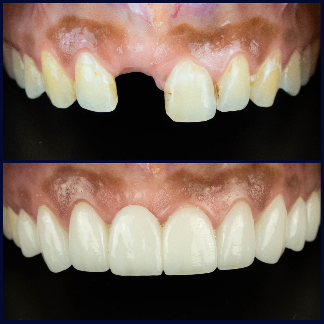 Left-Side-Extra-Oral-Before-and-After-3-porcelain-bridge-with-veneers