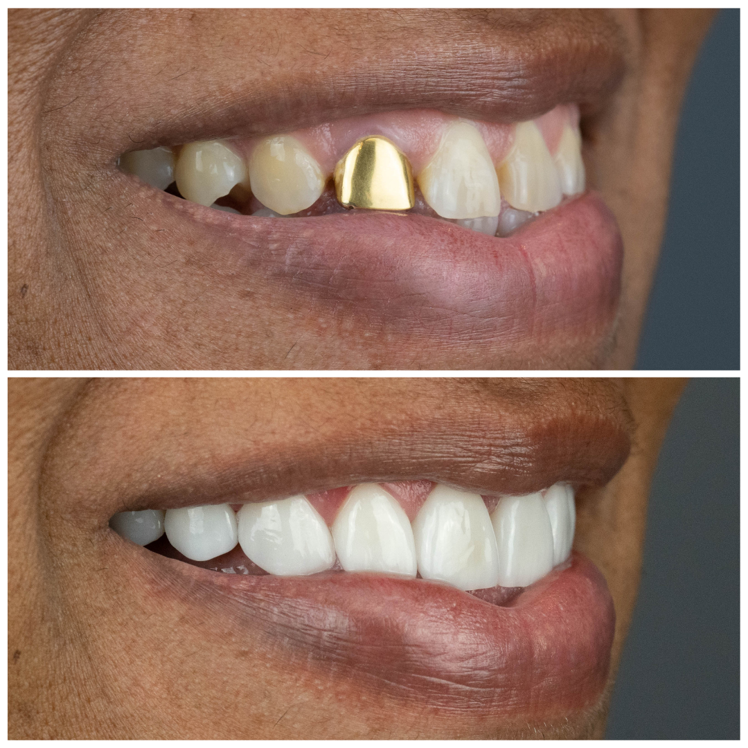 Right-Side-Extra-Oral-Before-and-After-veneers