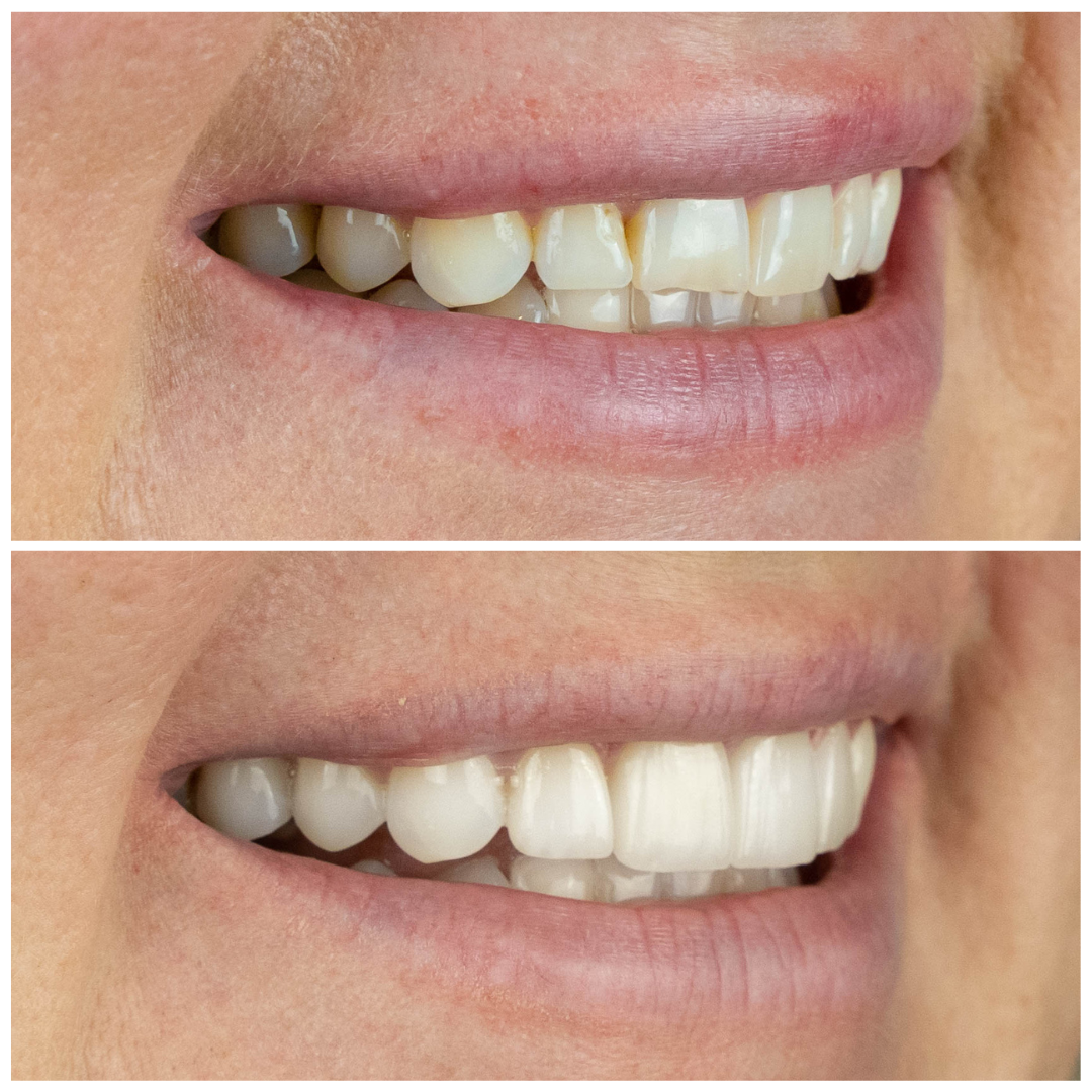 Veneers-Right-Side-Extra-Oral-Before-and-After-1