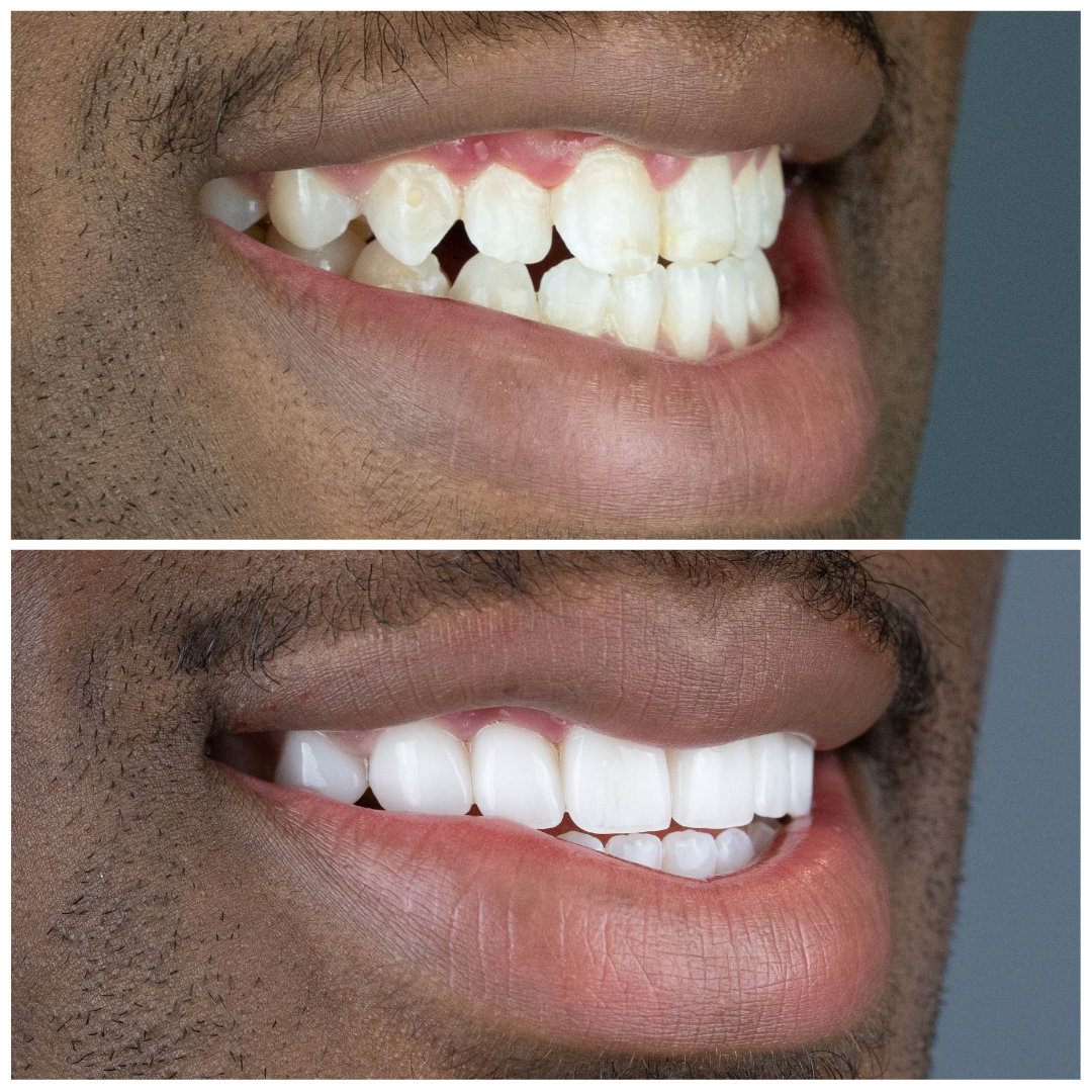 veneers-Left-Side-Extra-Oral-Before-and-After