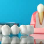 Benefits of Same-Day Dental Bridges in Cincinnati: Convenience and Efficiency