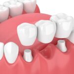 Is a Dental Bridge Right for You? Find Out Now!