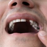 Best Options for Replacing Missing Teeth