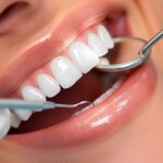 Composite Bonding Cost: What To Expect & Is It Worth It?
