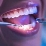How Composite Bonding Can Instantly Improve Your Smile